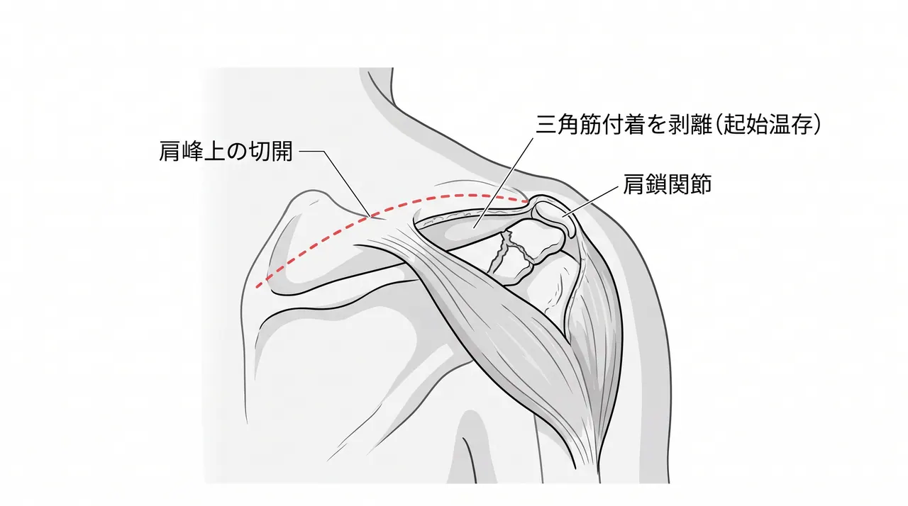 後上方アプローチ — 三角筋を分けて肩峰・肩鎖関節を展開