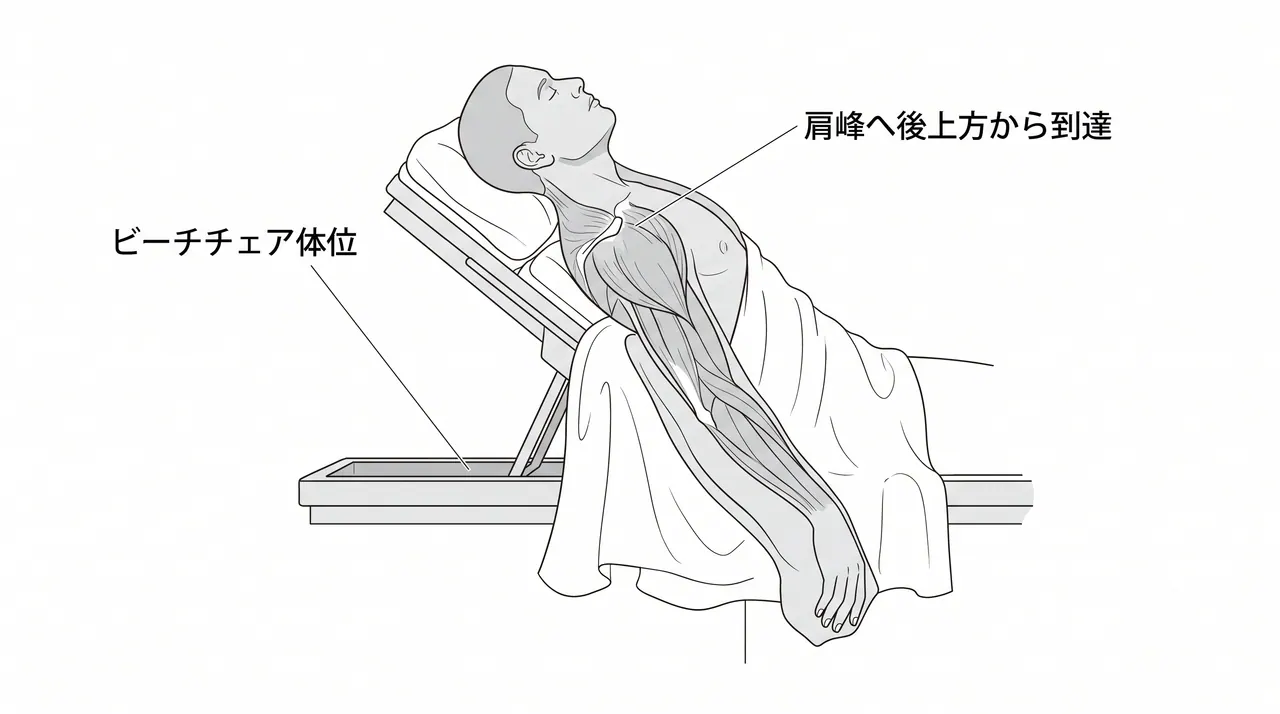 手術体位 — ビーチチェア体位または側臥位（後上方アプローチ）