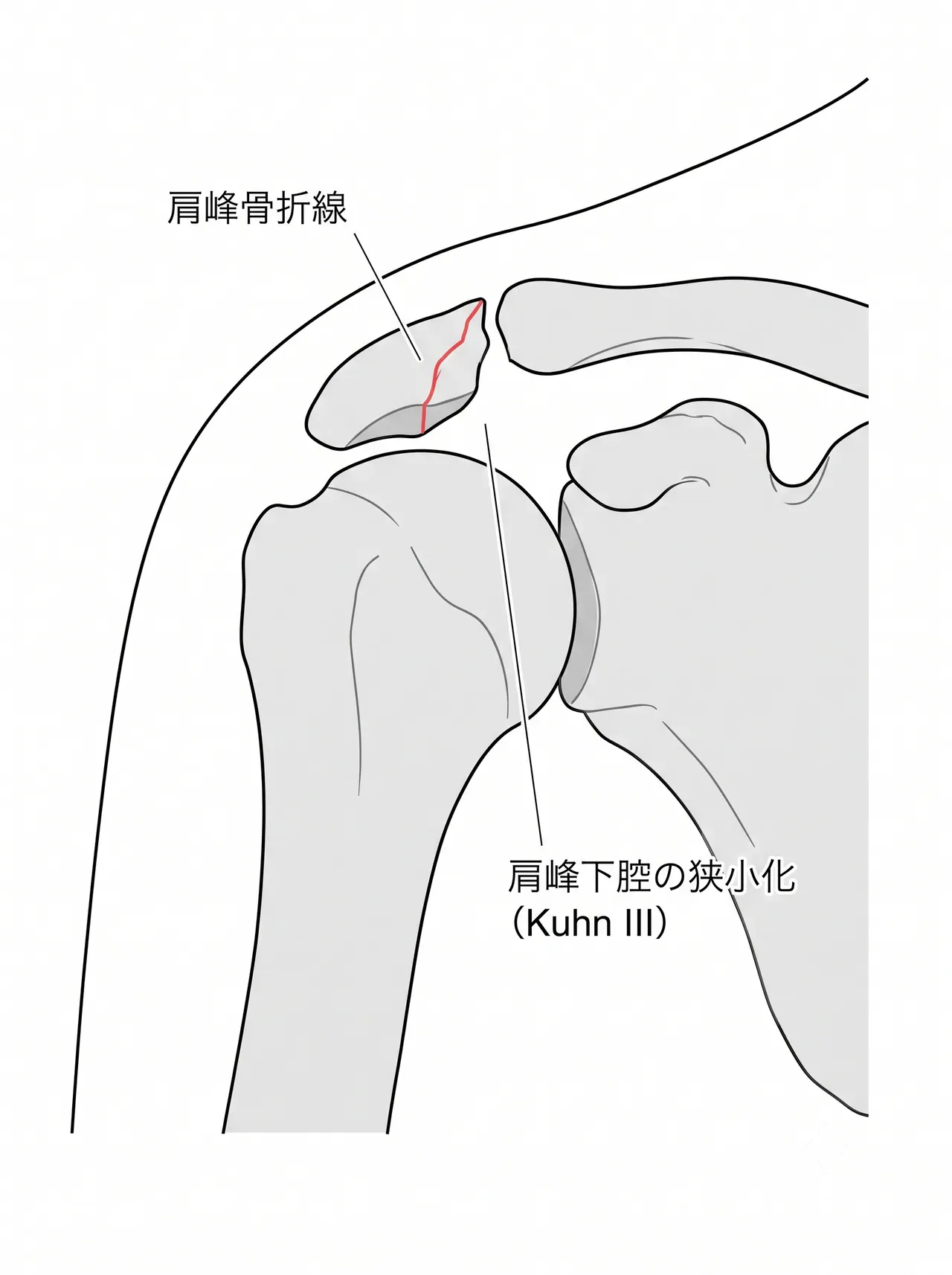 X線 — 肩甲骨正面・axillary viewによる肩峰骨折・肩峰下腔の評価