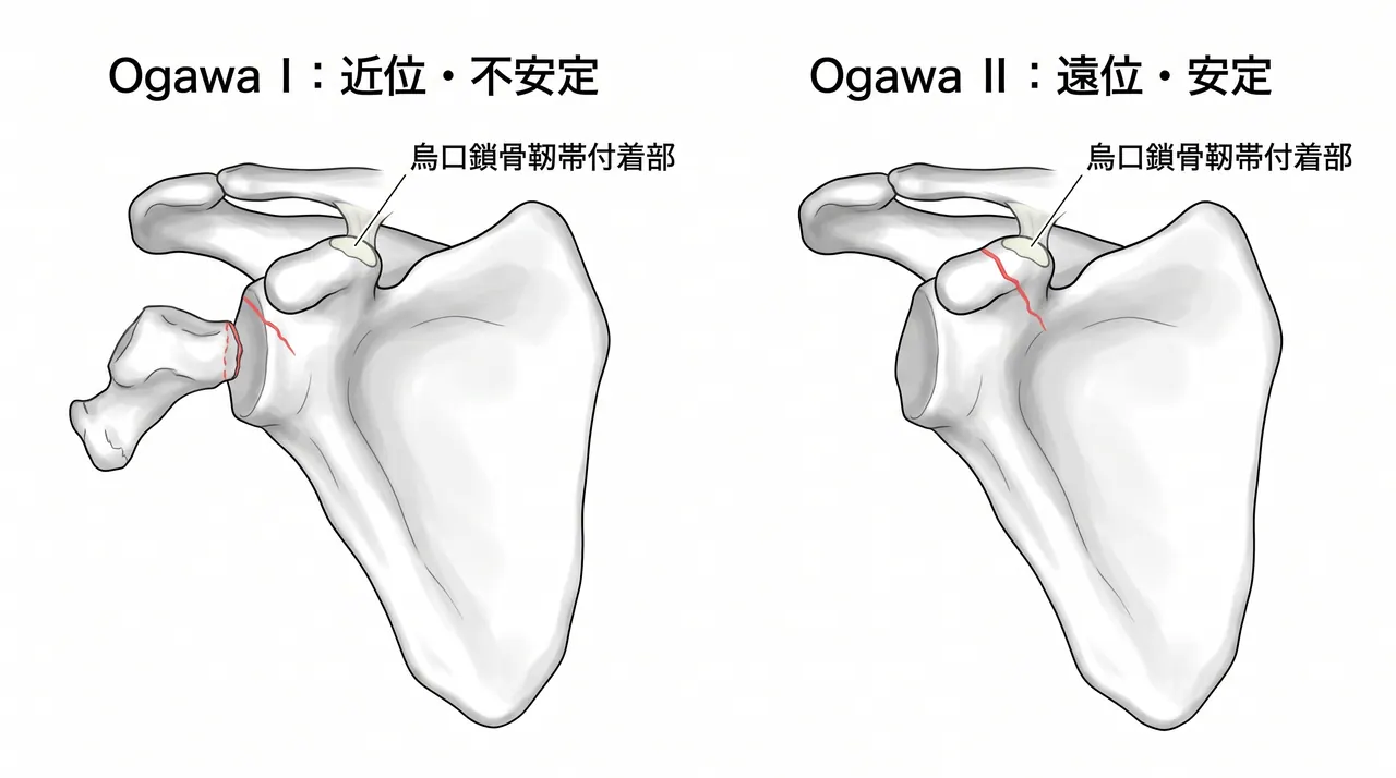 3D-CT — 骨折線と烏口鎖骨靱帯付着部の位置関係・転位量評価