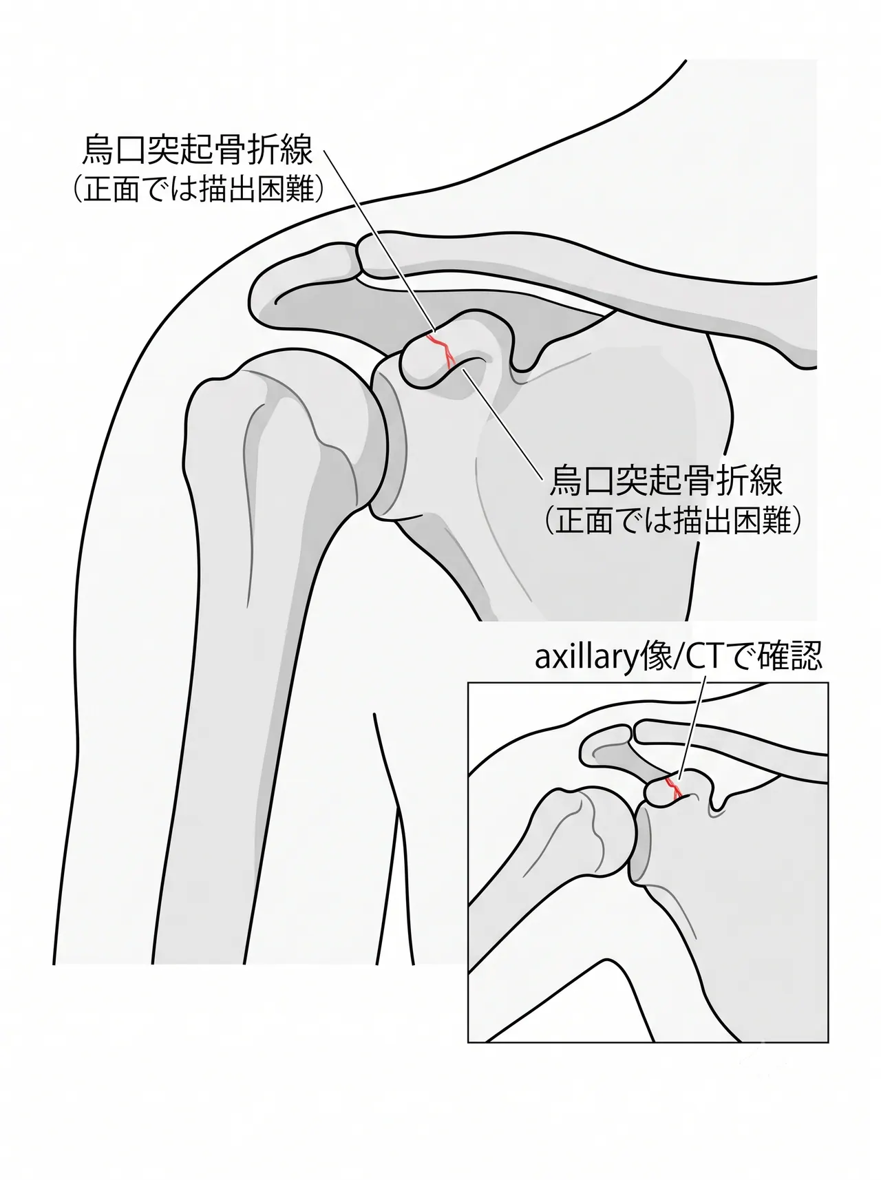 X線・axillary view — 烏口突起骨折の評価（描出困難なためCTを併用）