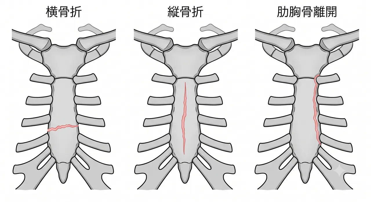 胸部CT 3D再構成 — 骨折部位（manubrium/corpus/xiphoid）と粉砕の把握