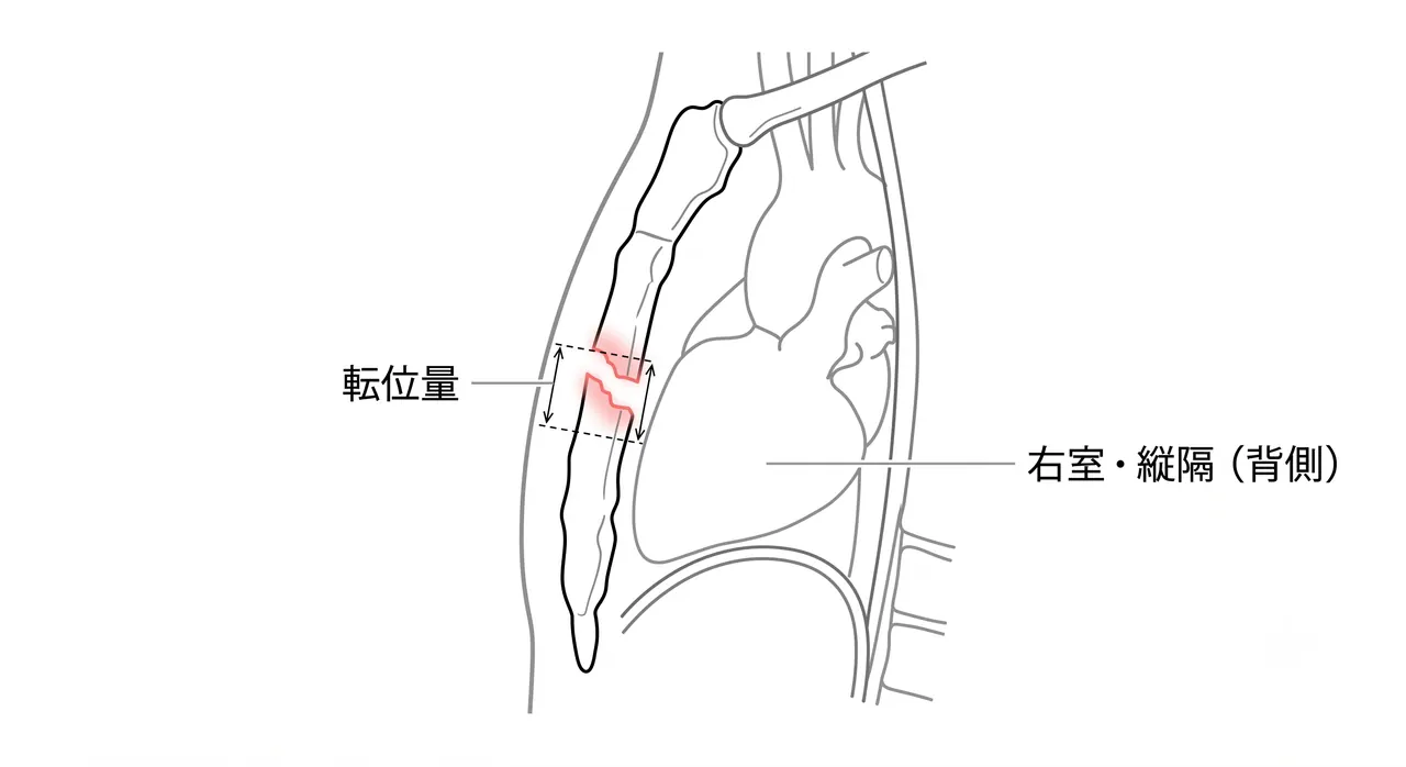 胸部CT矢状断 — 胸骨骨折線・前後転位・overlapの評価