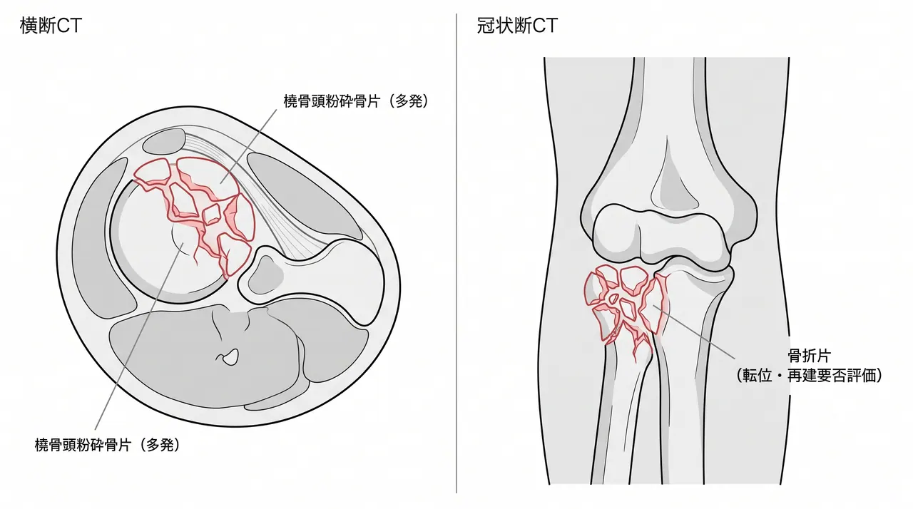 21-a3-ct-axial-coronal.png