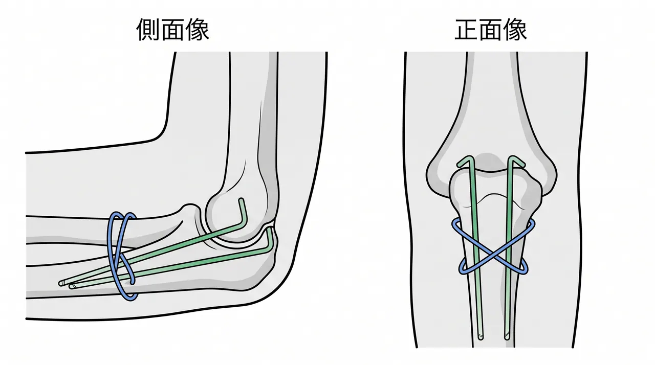 21-b1-postop-xray.png