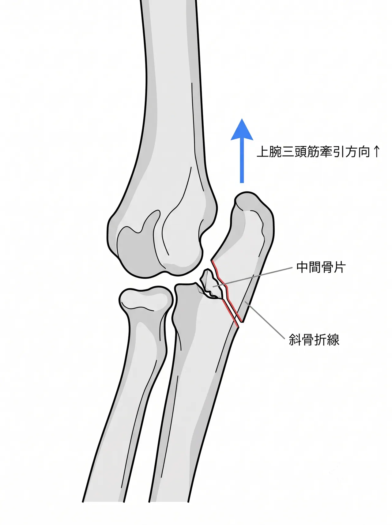 21-b2-xray-lateral.png