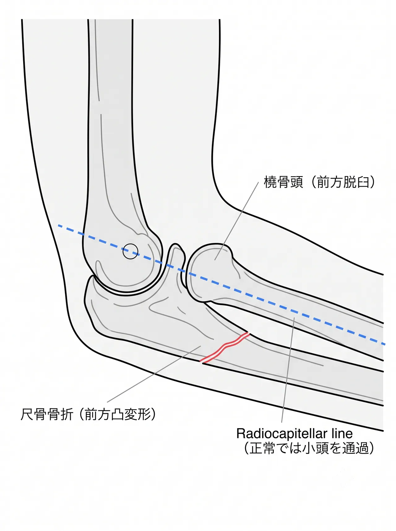 21-b3-xray-lateral.png