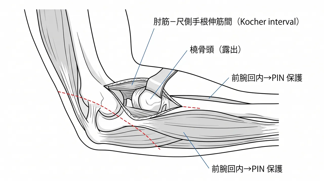 21-c1-kocher-approach.png