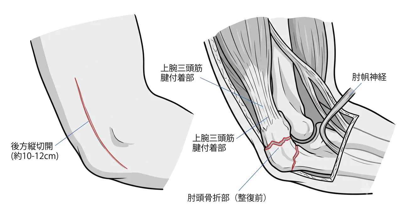 21-c1-olecranon-approach.png