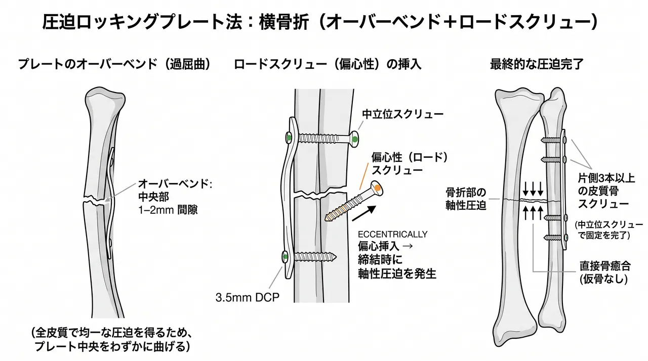 圧迫プレーティング（横骨折）— オーバーベンドと偏心スクリューによる軸圧迫