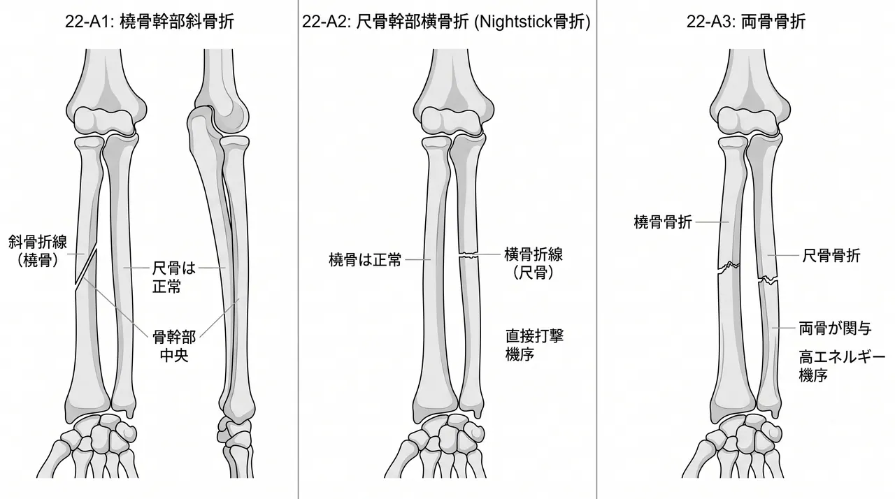 X線像 — 前腕骨骨幹部単純骨折パターン（22-A1: 橈骨斜骨折、22-A2: 尺骨横骨折、22-A3: 両骨骨折）
