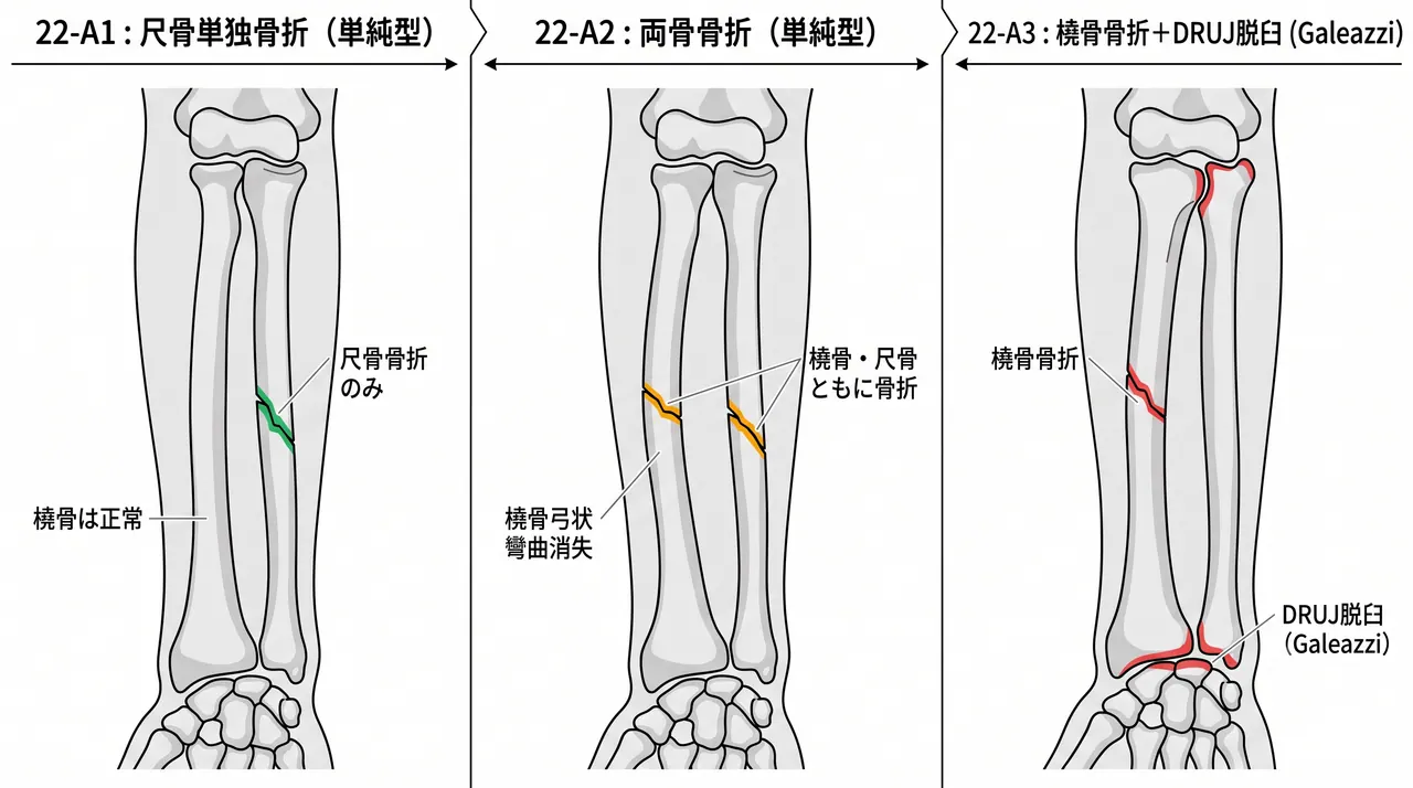 骨折パターン比較 — 22-A1（橈骨単純骨折）vs 22-A2（尺骨単純骨折 / 両骨単純骨折）vs 22-A3（橈骨・尺骨両骨単純骨折）