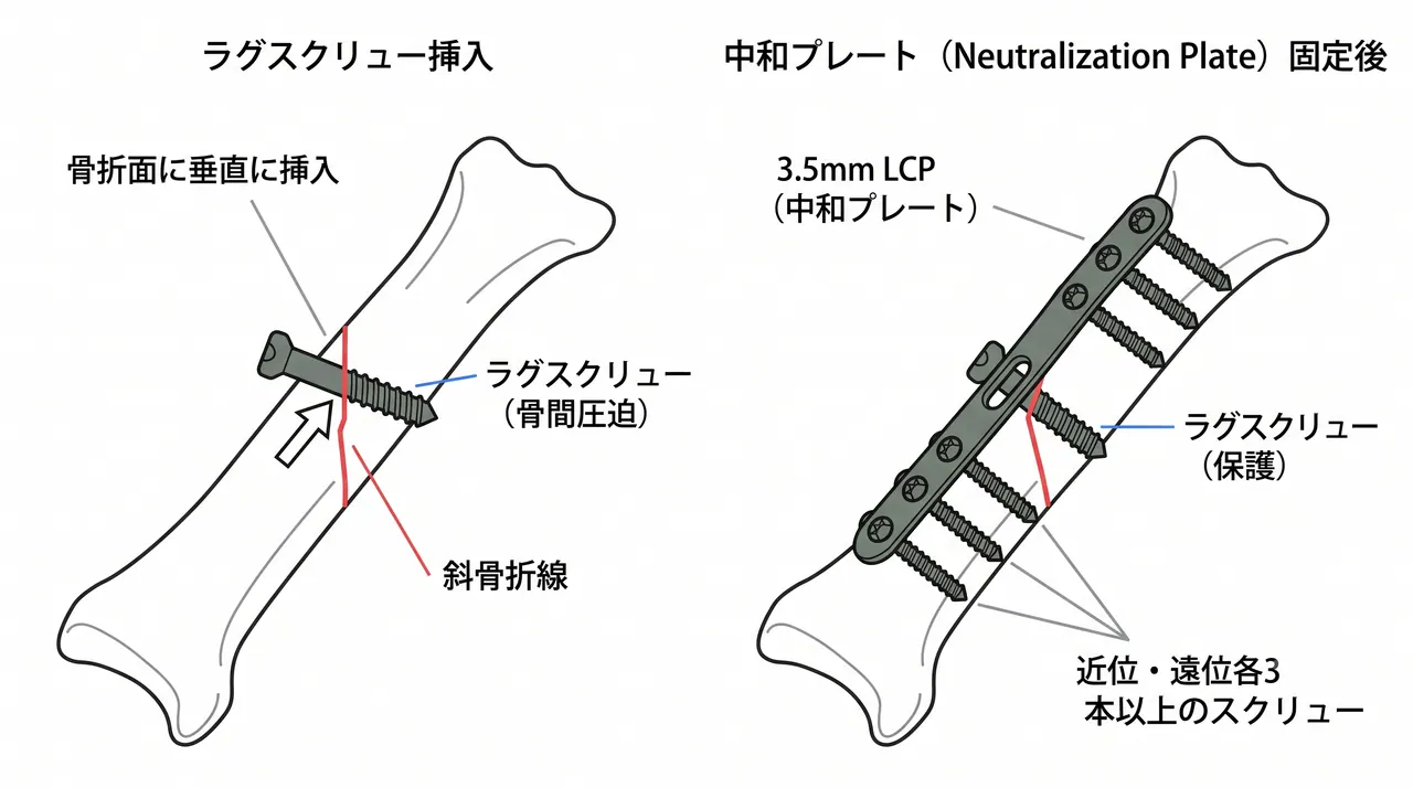 橈骨 ラグスクリュー挿入（斜骨折タイプ・骨折面垂直方向）
