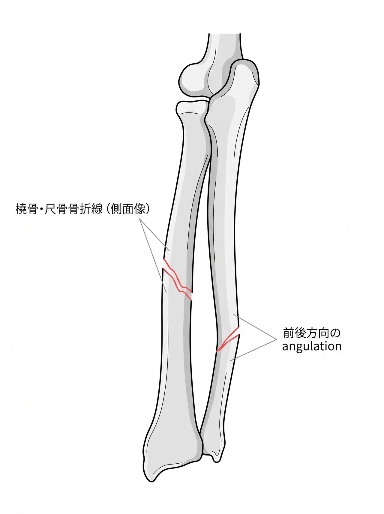 X線側面像 — 前腕骨両骨折（掌背側変位の評価）