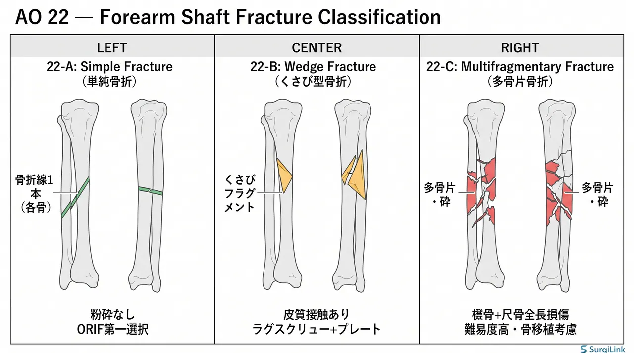 骨折パターン分類 — 22-A3（単純）vs 22-B（くさび型）vs 22-C（多骨片型）