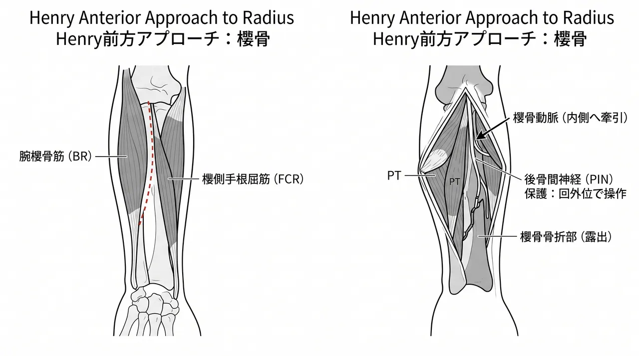 Henryアプローチ — 橈骨前方アプローチ（腕橈骨筋・橈側手根屈筋間）