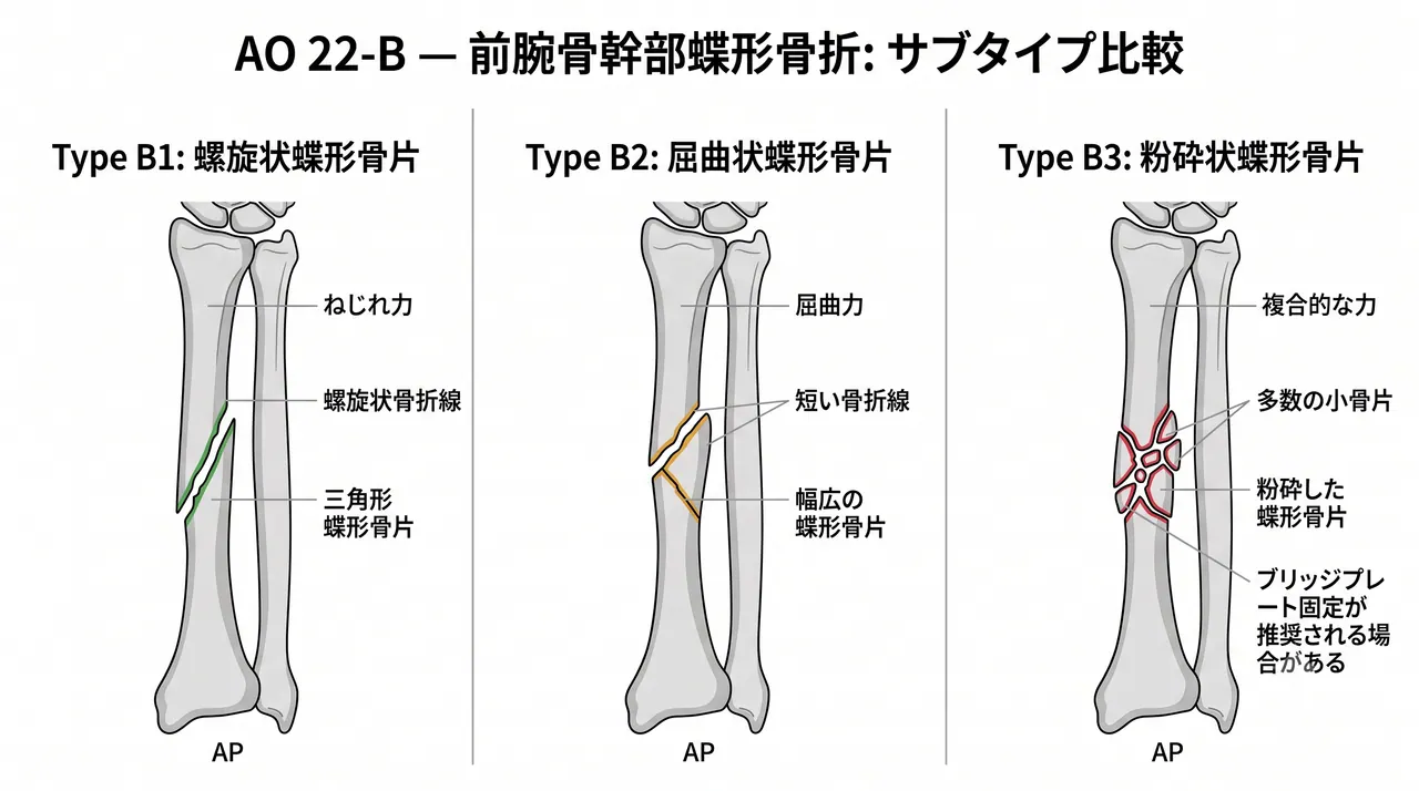 骨折パターン比較 — 22-B1（螺旋楔状）vs 22-B2（屈曲楔状）vs 22-B3（粉砕楔状）