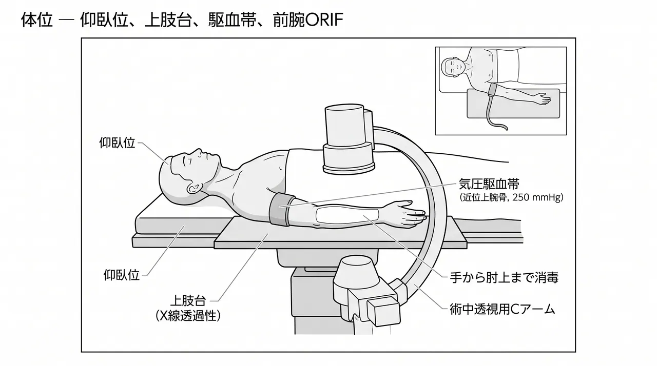 手術体位 — 仰臥位・患肢を上肢台に乗せ、上腕駆血帯を装着