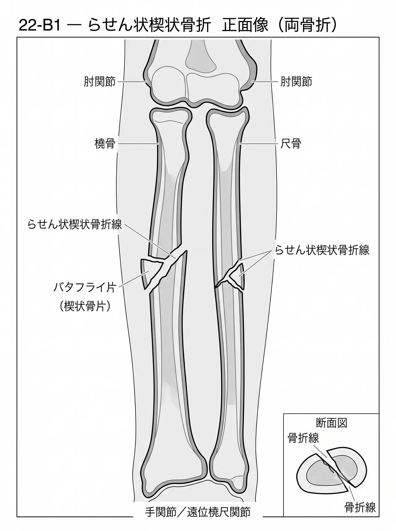 X線正面像 — 前腕骨骨幹部楔状骨折（橈骨・尺骨の螺旋楔状パターン）