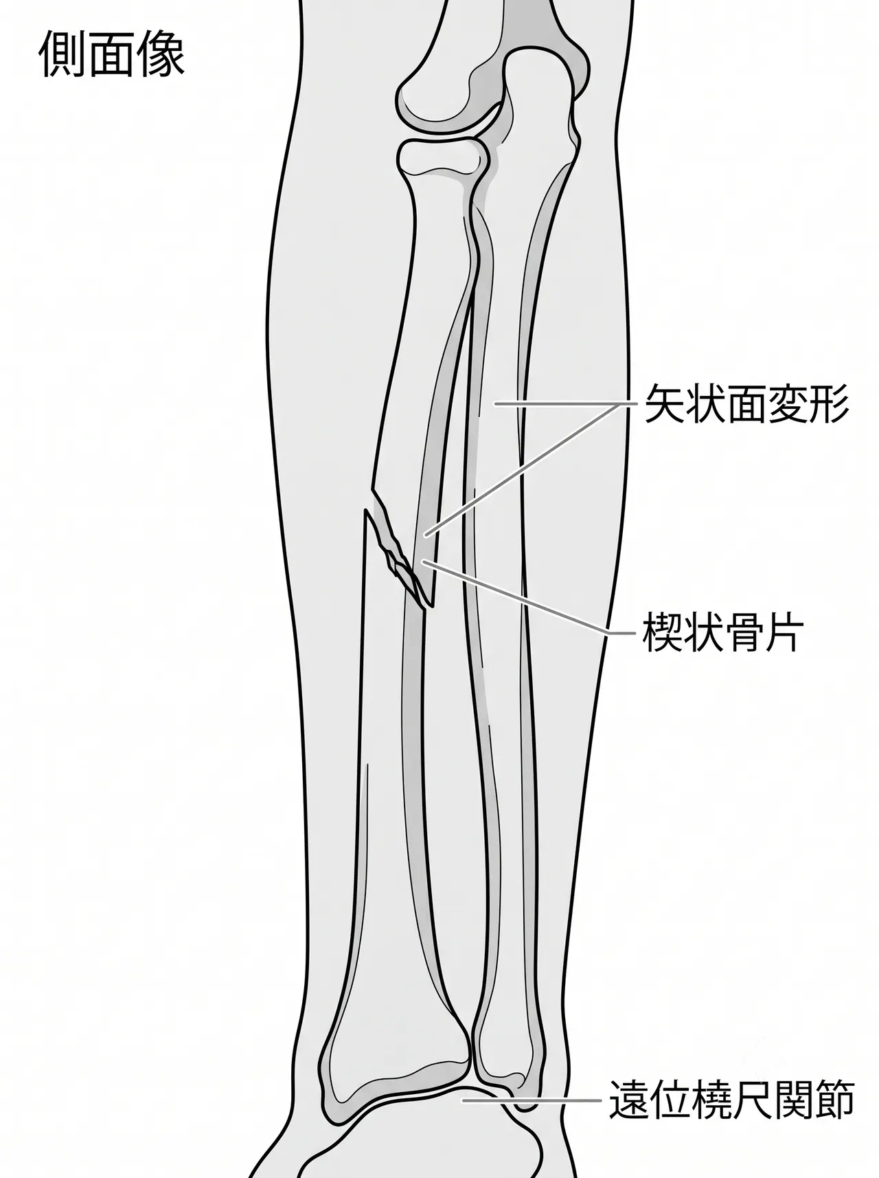 X線側面像 — 前腕骨楔状骨折（側面での骨片転位確認）