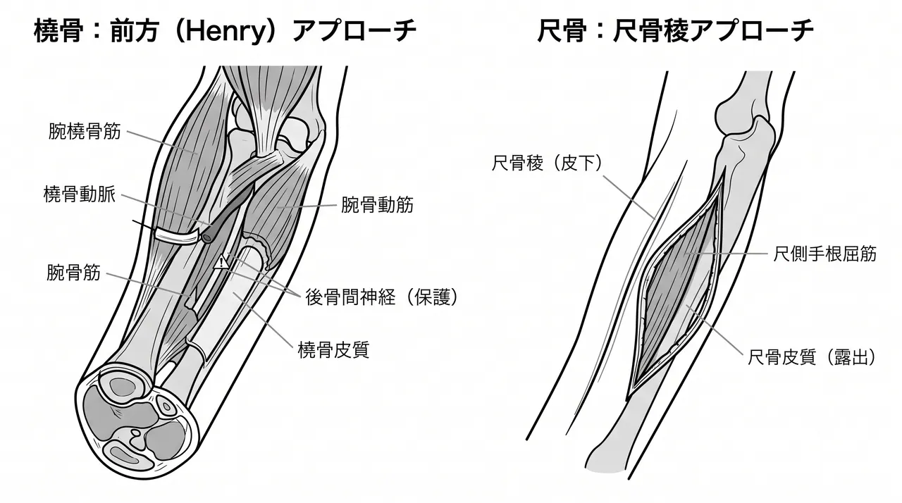 前腕アプローチ — 橈骨（前方Henry法）と尺骨（尺骨稜沿い）の展開解剖