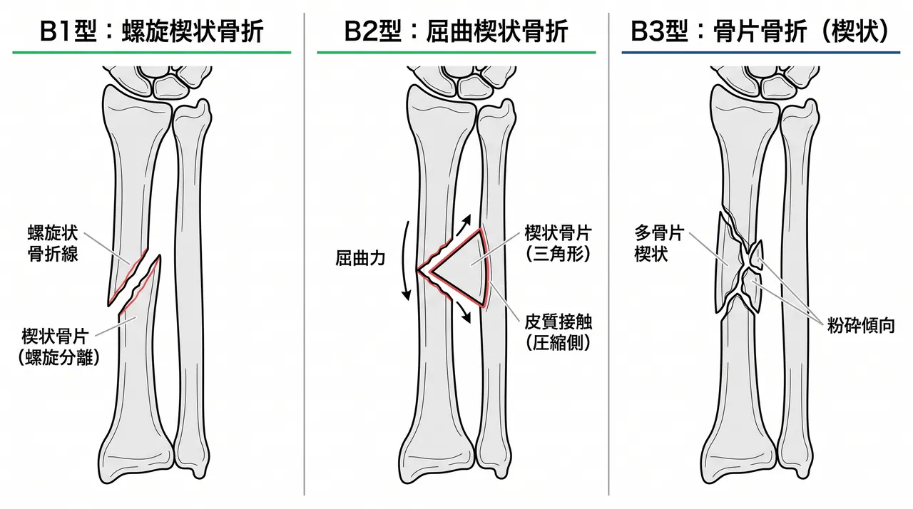 骨折パターン比較 — 22-B1（螺旋楔状）vs 22-B2（屈曲楔状）vs 22-B3（骨片骨折）