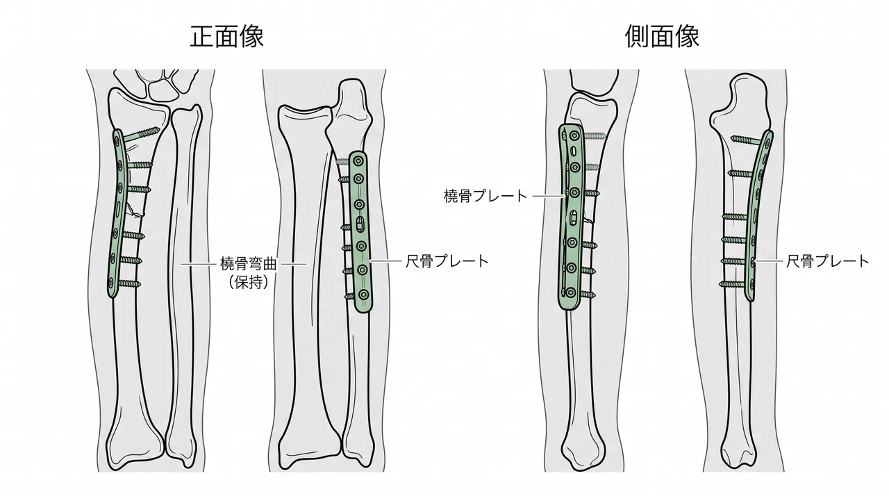 術後X線像（正面/側面）— 橈骨・尺骨プレート固定後（楔状骨片のラグスクリュー固定を含む）