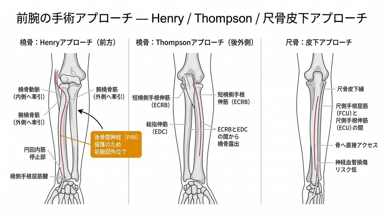 前腕骨へのアプローチ — 橈骨（Henry法/Thompson法）と尺骨（皮下アプローチ）