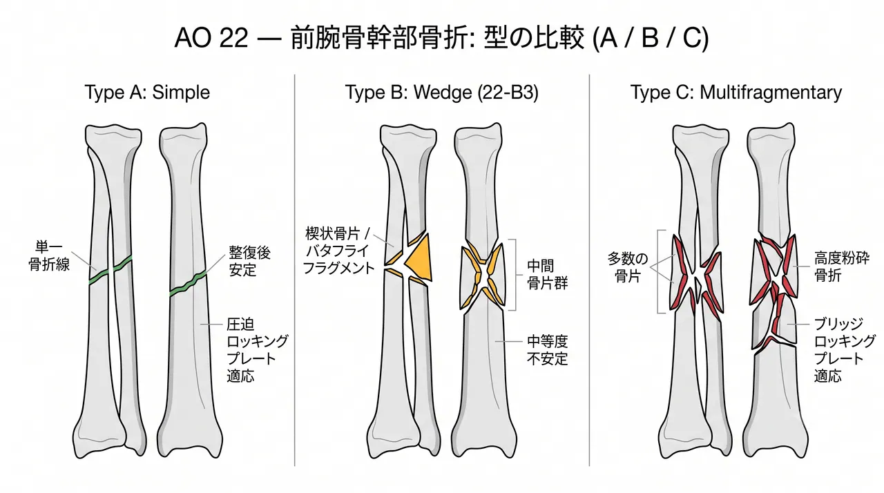骨折パターン比較 — 22-A（単純）vs 22-B（楔状）vs 22-C（粉砕）前腕骨骨幹部骨折