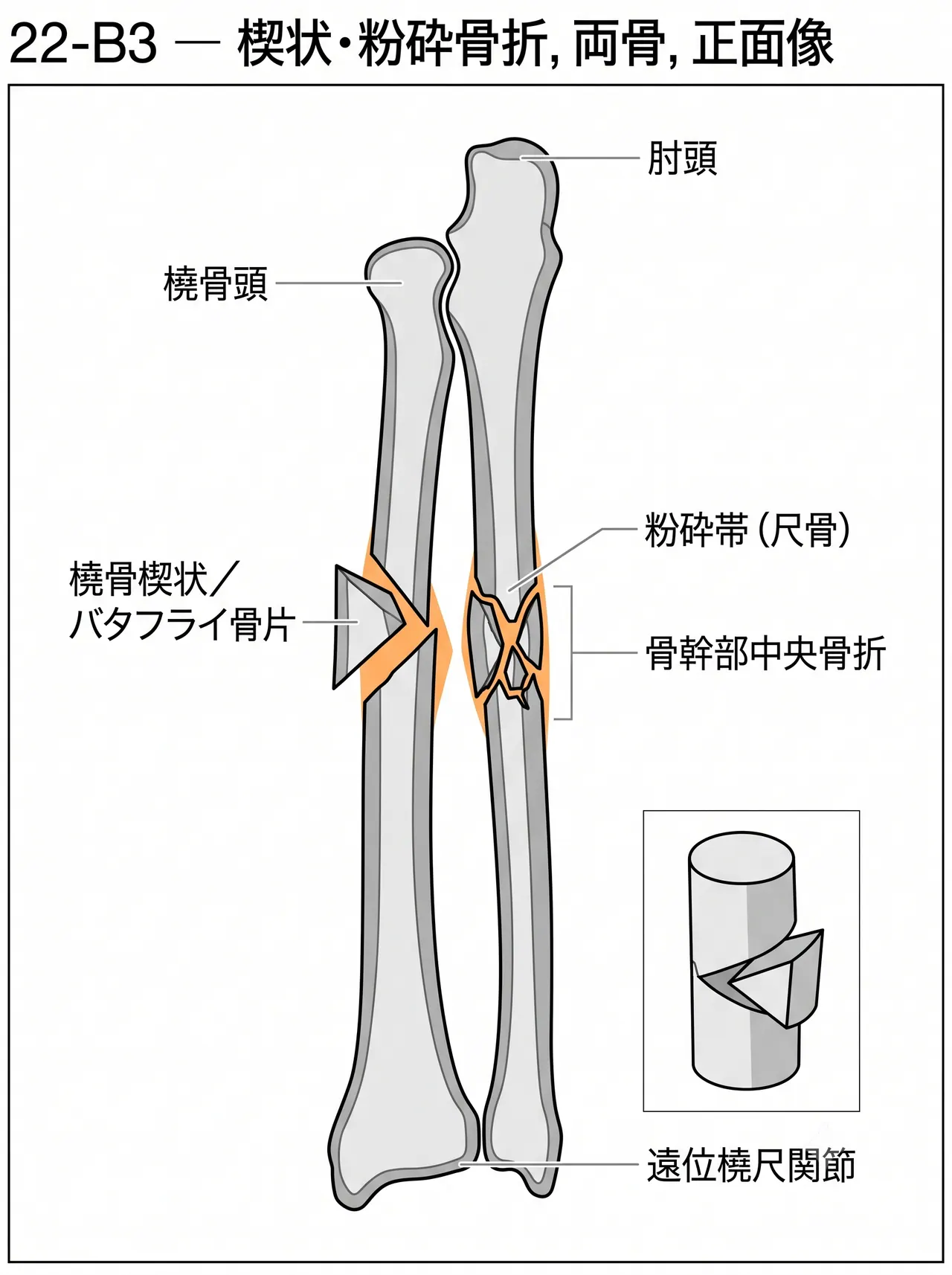 X線正面像 — 前腕骨骨幹部楔状・粉砕骨折パターン（橈尺骨両骨）