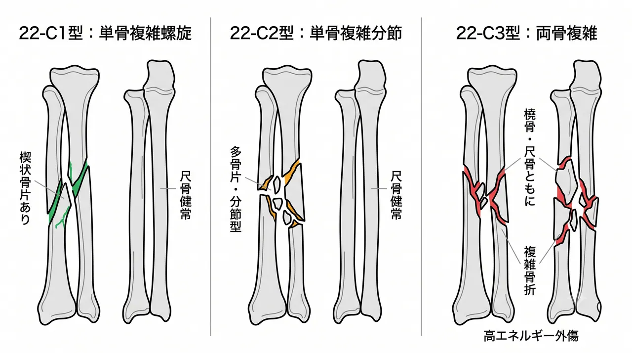 骨折パターン比較 — 22-C1（単骨複雑螺旋）vs 22-C2（単骨複雑分節）vs 22-C3（両骨複雑）