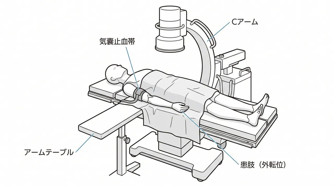 手術体位 — 仰臥位・アームテーブル使用（気囊止血帯装着）