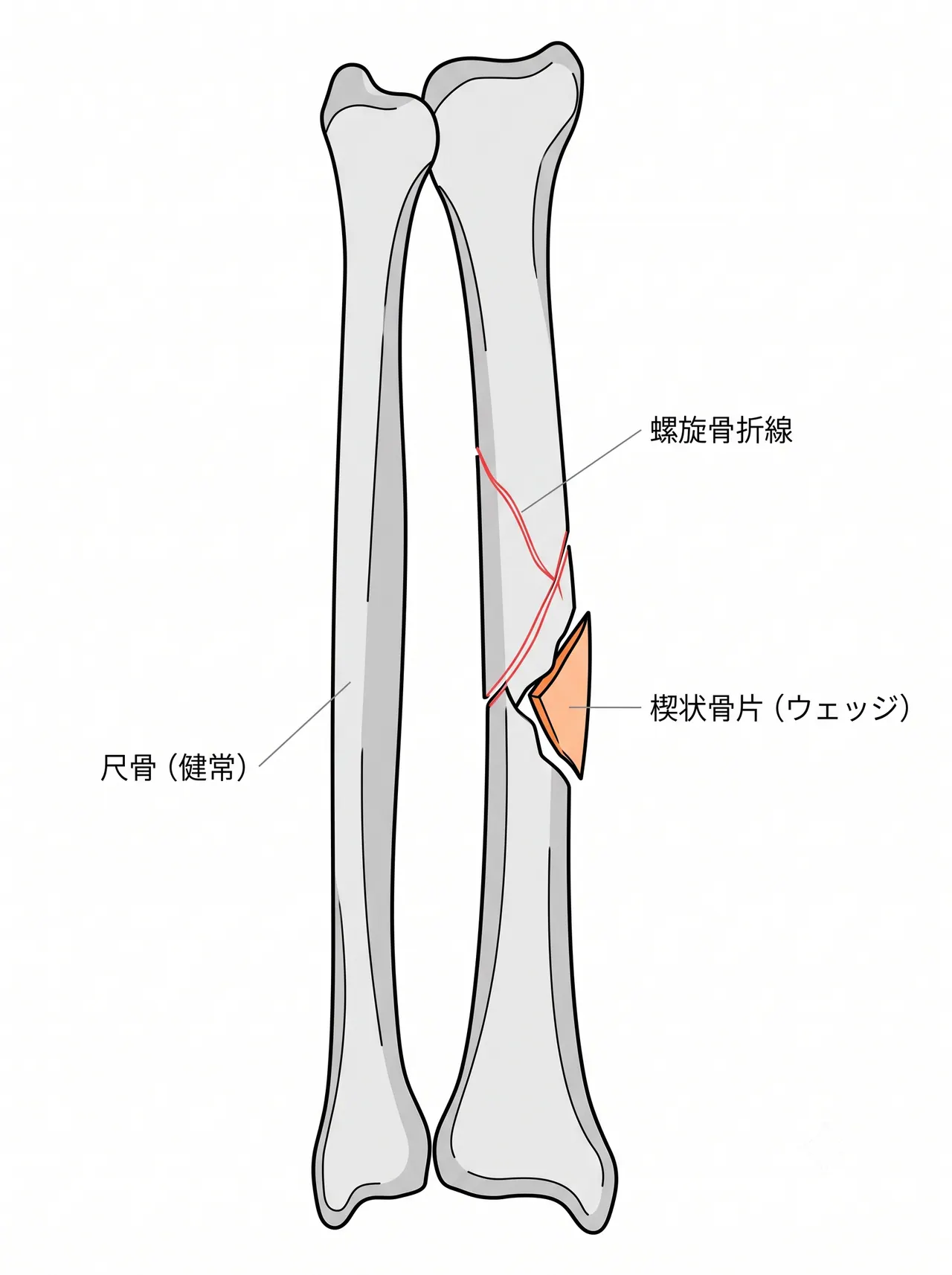 X線正面像 — 橈骨骨幹部複雑螺旋骨折（楔状骨片）のパターン