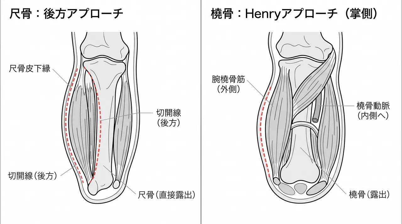アプローチ解剖 — 尺骨皮下アプローチ（後方）および橈骨Henryアプローチ（掌側）