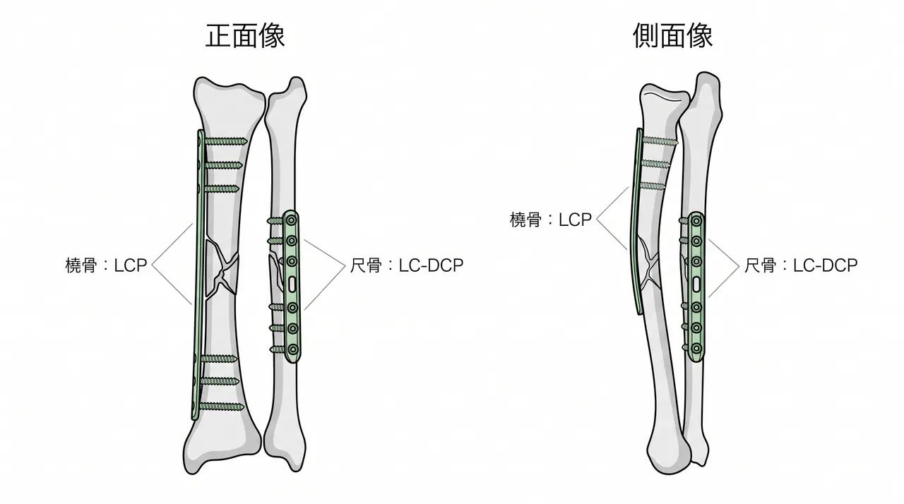 術後X線（正面/側面）— 橈骨LCP＋尺骨LC-DCP によるブリッジプレート固定後