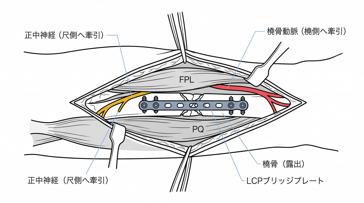 橈骨 Henry アプローチ — 橈骨動脈・FPL・PQ 間の展開