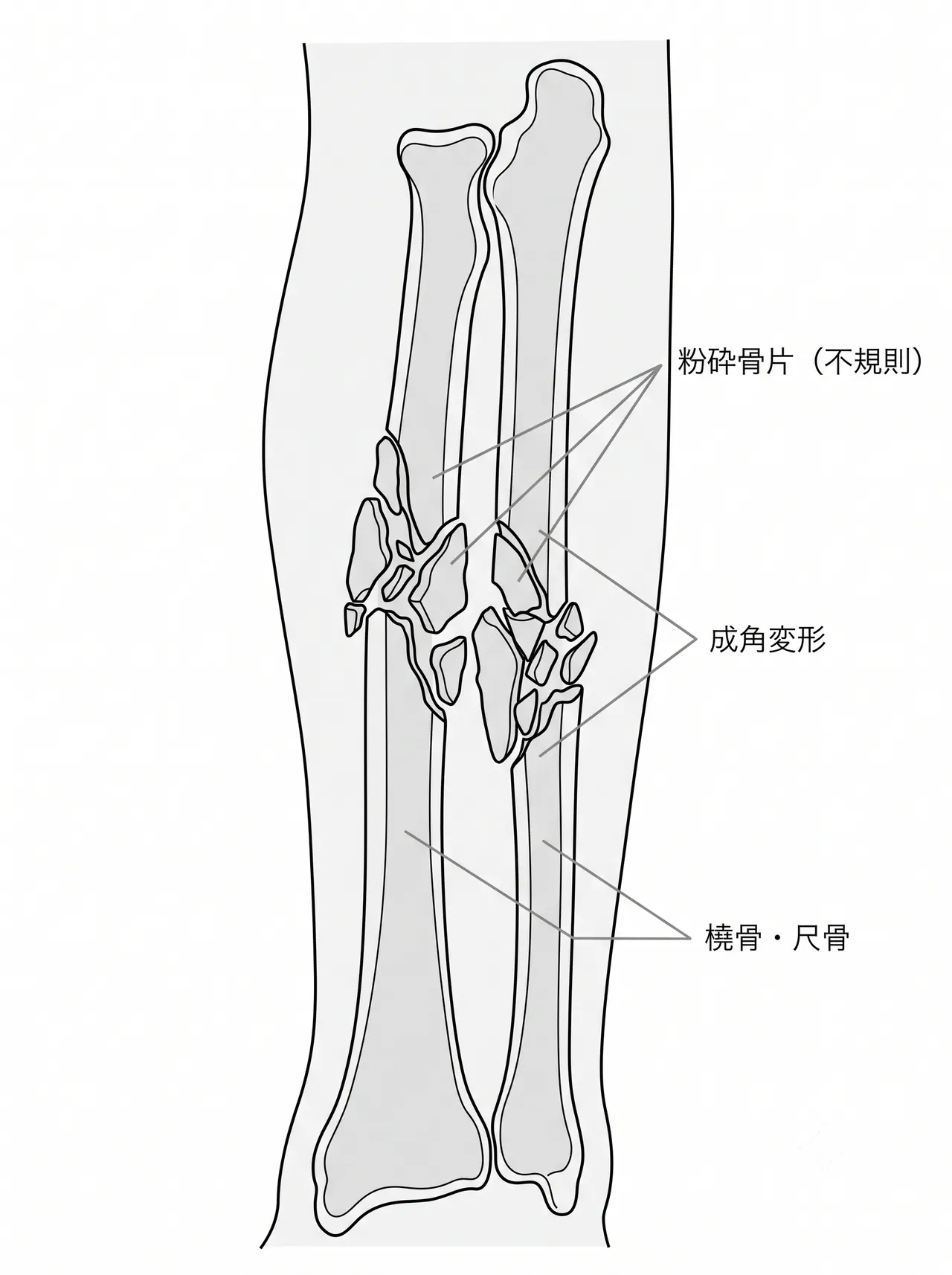 X線側面像 — 前腕の短縮・成角・粉砕骨片の分布