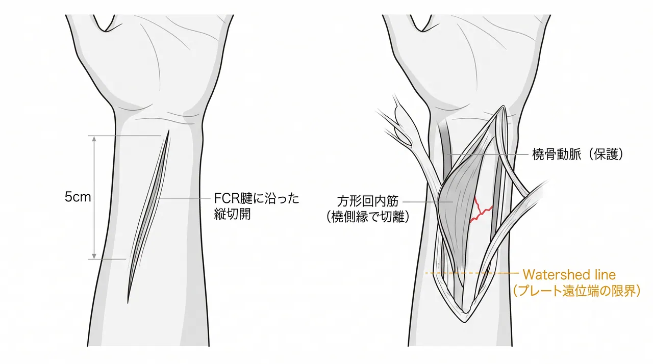 掌側アプローチ解剖図 — 修正Henry法による橈骨掌側面展開・方形回内筋剥離・橈骨遠位端露出