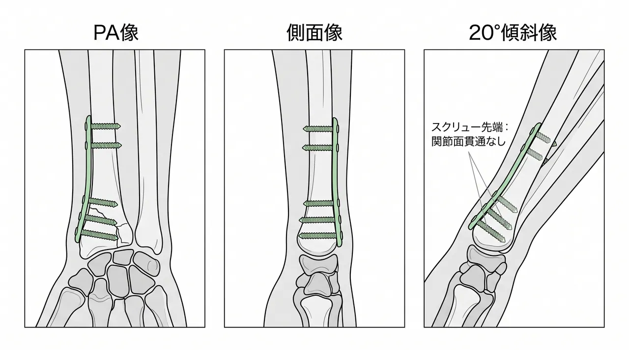 術中透視（PA / 側面 / 20°傾斜像） — 遠位スクリュー関節面貫通なし・掌側傾斜回復・橈骨高径確認