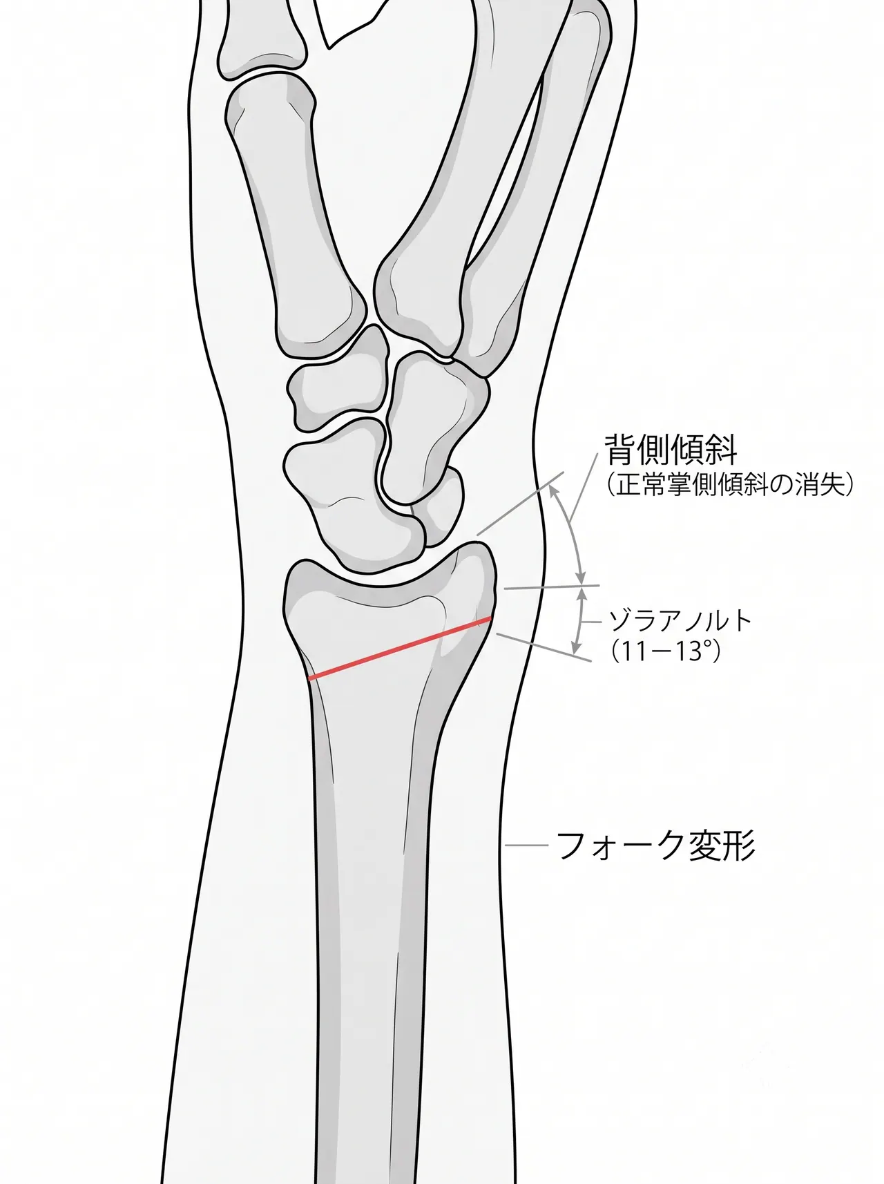 術前X線側面像 — 掌側傾斜角の背側傾斜への転換・背側皮質粉砕・フォーク変形の評価