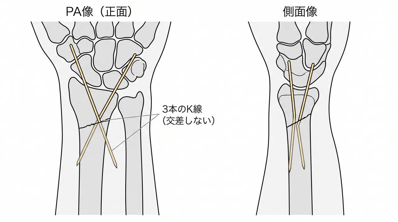 経皮的K線固定の透視像 — 橈骨茎状突起からの2本と背尺側からの1本のK線配置（PA像・側面像）
