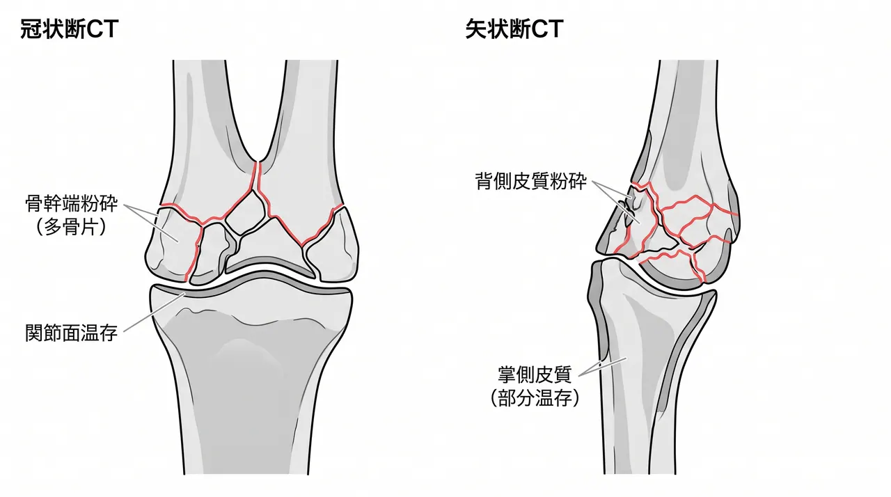 CT横断面・矢状断面 — 骨幹端粉砕パターン・掌側皮質の状態・関節面温存の確認（23-B/Cとの鑑別）
