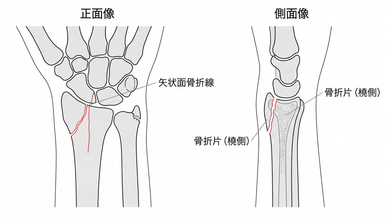 術前X線正面像・側面像 — 橈骨遠位部矢状面骨折線・関節面転位量・尺骨茎状突起骨折合併・掌側傾斜角・橈骨傾斜角を評価