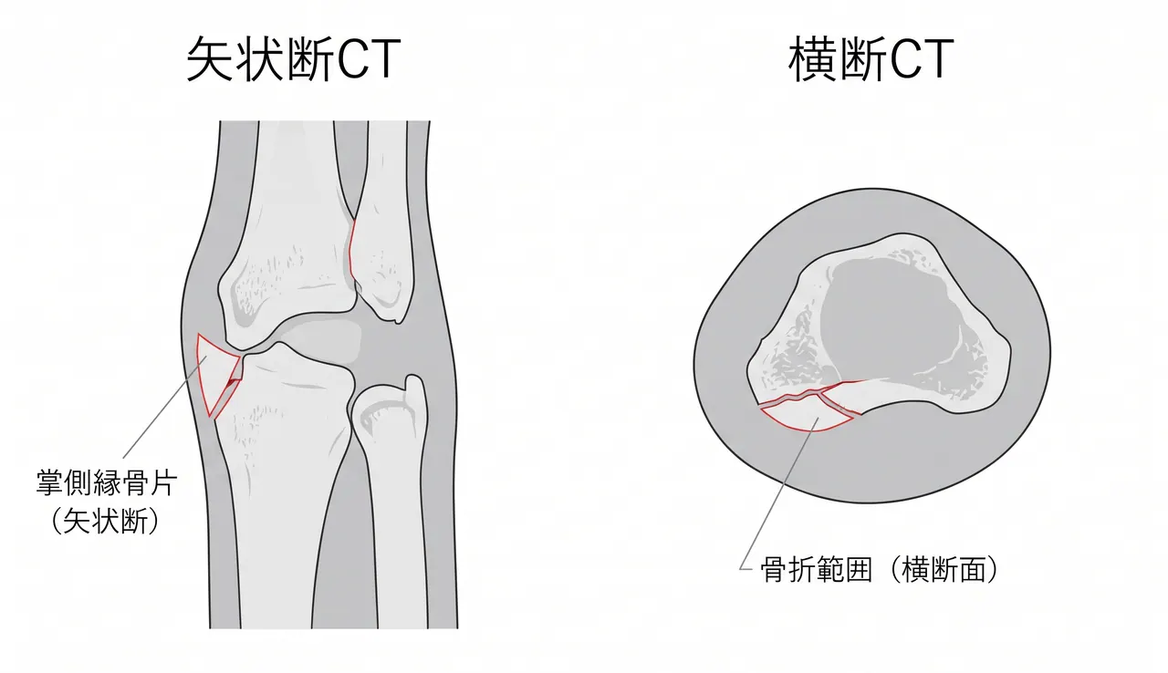 CT矢状断・横断面 — 掌側縁骨片のサイズ・転位量・骨折線の範囲・DRUJの評価。術前プレート選択の根拠となる