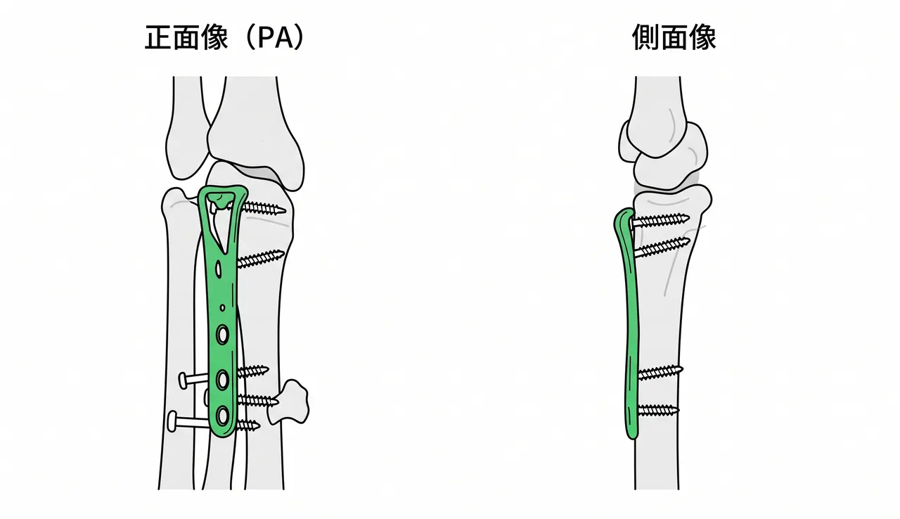 術後X線PA像・側面像 — 掌側ロッキングプレート（VLP）固定後。掌側縁骨片の整復・手根骨アライメント復元・プレート位置の評価