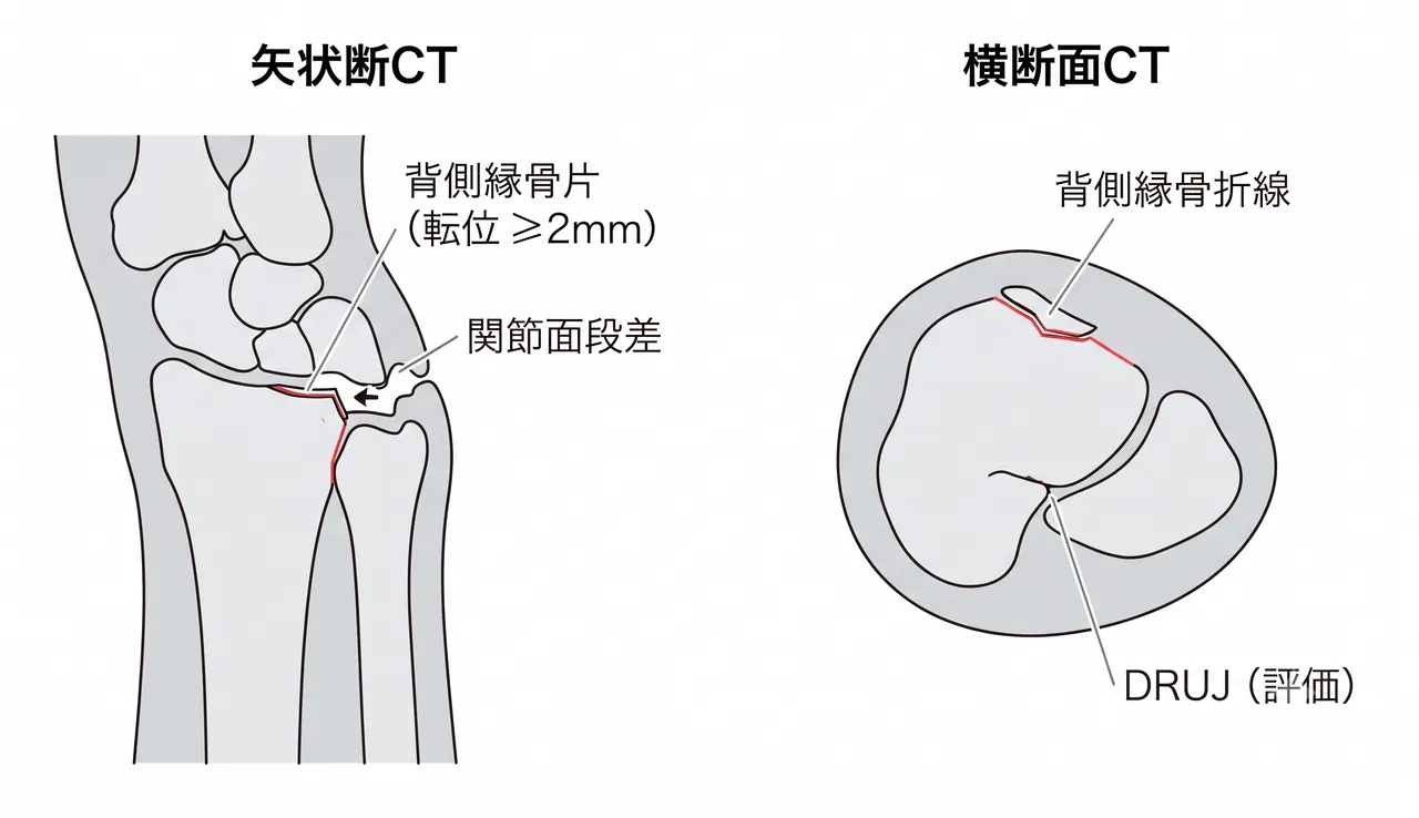 CT矢状断・横断面 — 背側縁骨片の大きさ（関節面積の割合）・粉砕度・月状骨・DRUJの整合性を三次元評価