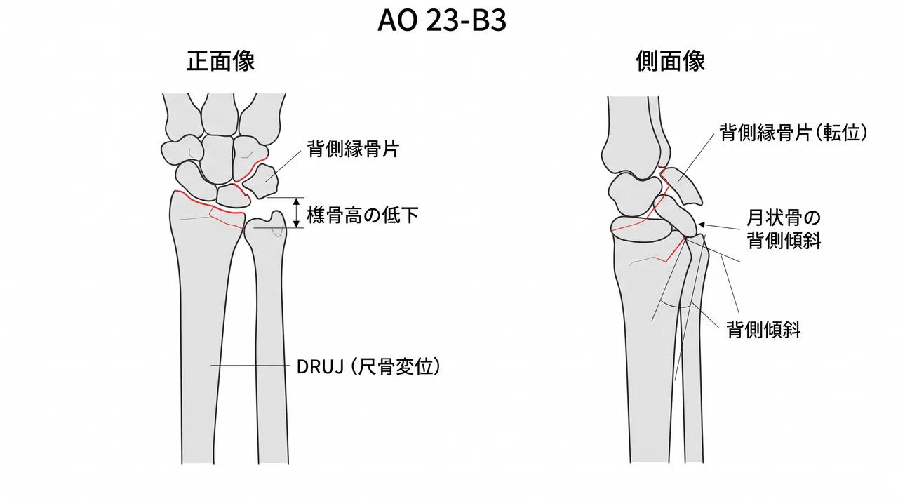 術前X線正面像・側面像 — 橈骨遠位背側縁の骨片分離・月状骨との位置関係・橈骨高・尺骨変位を評価