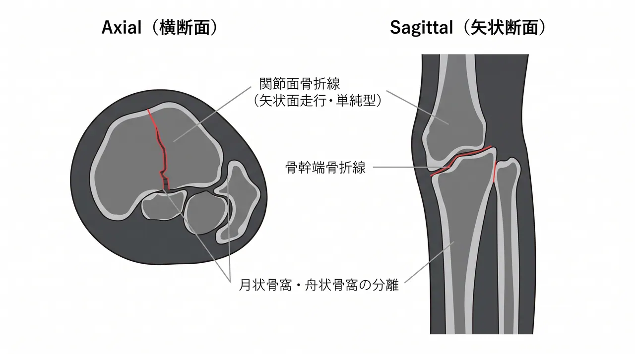 術前CT横断面・矢状断面 — 関節面骨折線の方向（矢状面または前額面）・月状骨窩と舟状骨窩の分離・転位量の三次元評価