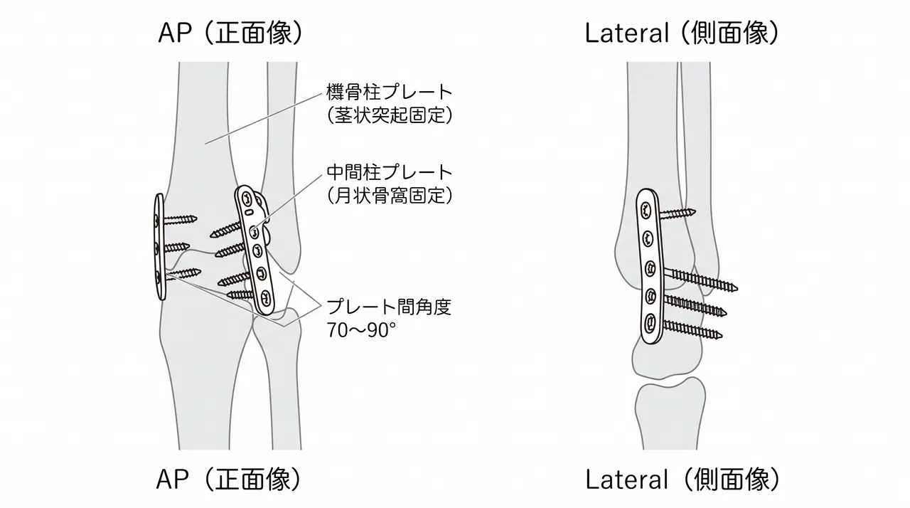 背橈側ダブルプレート術中透視 — 橈骨柱プレート（橈骨茎状突起固定）＋中間柱プレート（月状骨窩背側固定）の配置（正面像）