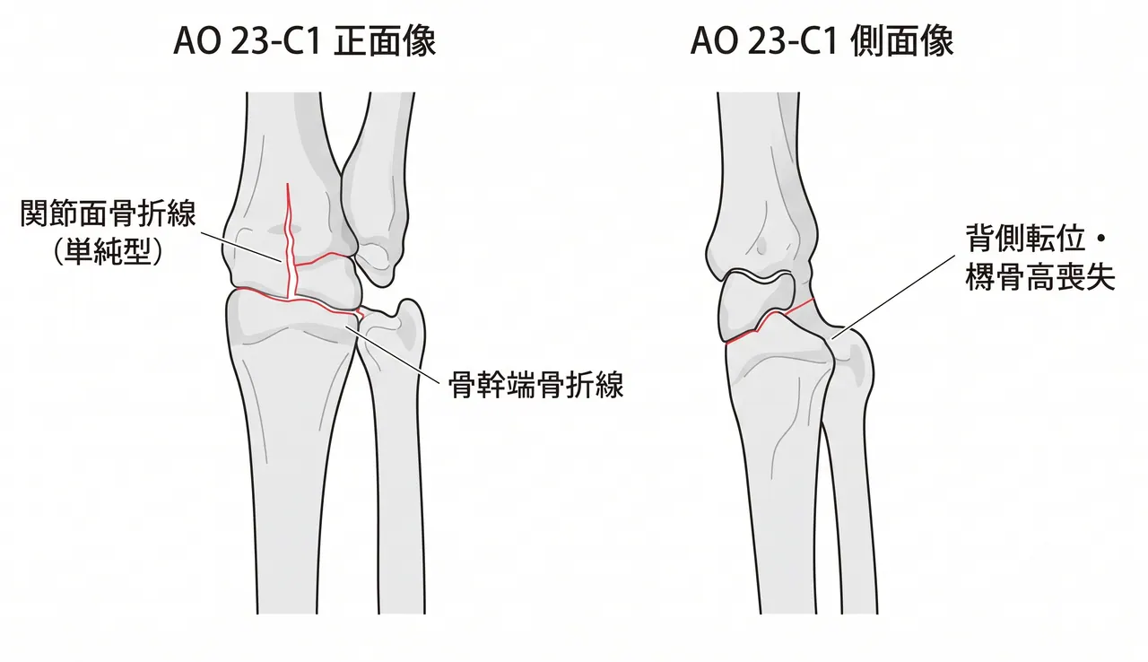 術前X線正面像・側面像 — 橈骨遠位完全関節内骨折（23-C1）。正面像で橈骨高喪失・尺骨プラス変形、側面像で背側転位・掌側傾斜消失を評価